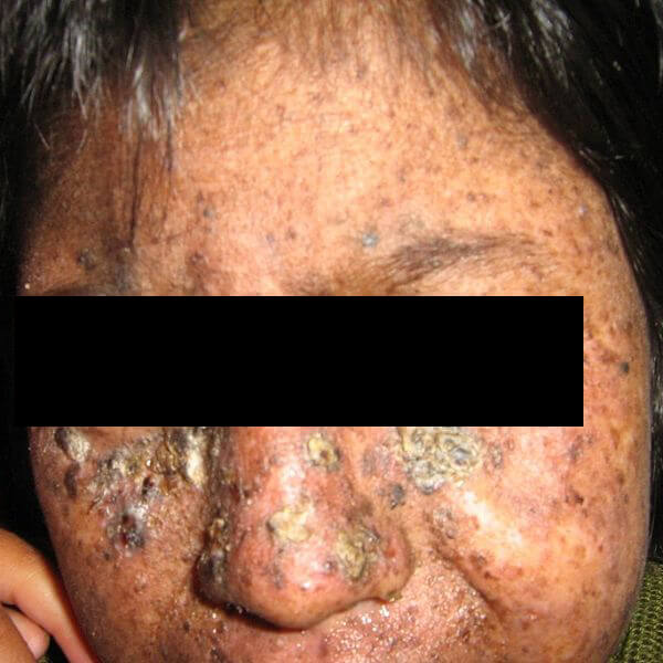Xeroderma Pigmentosum Xp Welcome To Clinuvel
