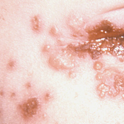 Herpes simplex symptoms on the eye Herpes simplex symptoms on the eye
