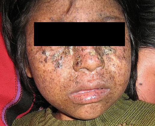 Xeroderma Pigmentosum Xp Welcome To Clinuvel