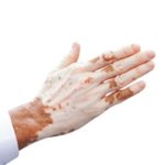 Pigment loss as seen in vitiligo