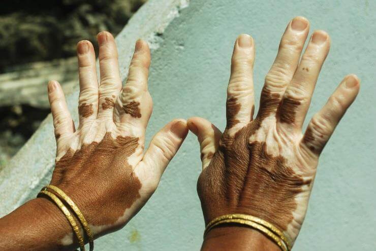 Figure 2: Hands of an African American vitiligo patient