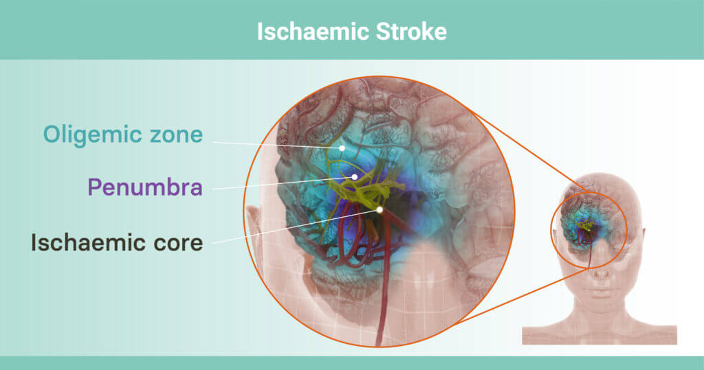 Ischaemic stroke, detail of the core