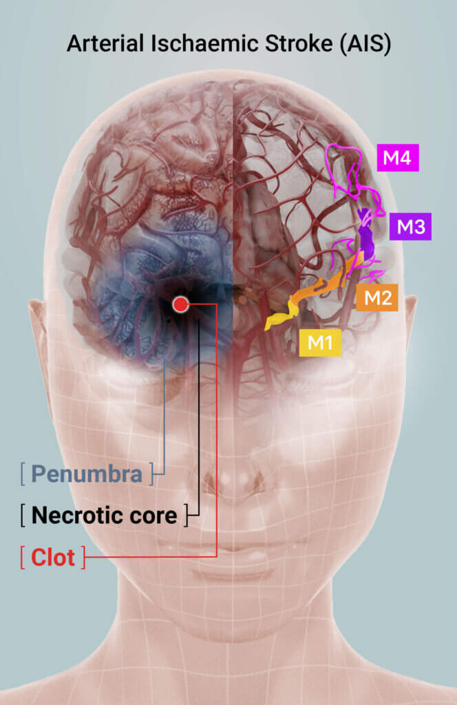 The middle cerebral artery and its segments