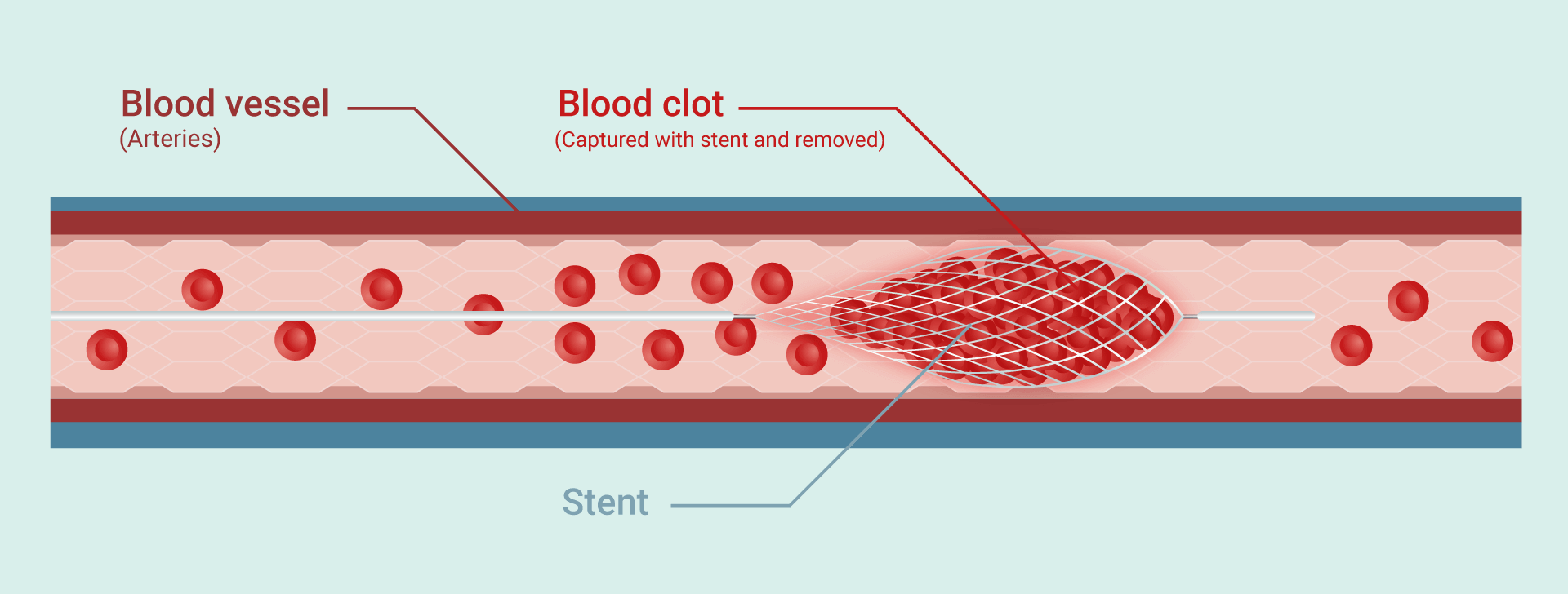 Brain arterial stent