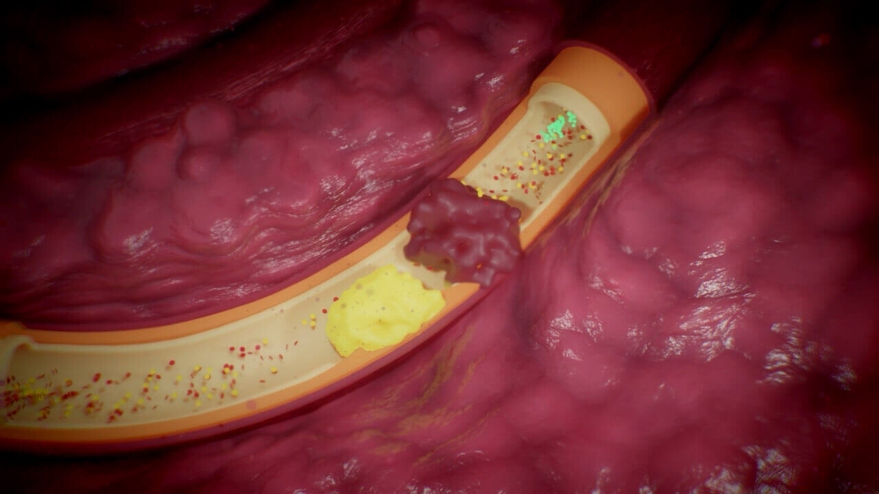 Stroke treatment, thrombolysis