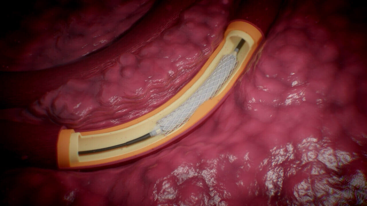 Stroke treatment, mechanical thrombolysis