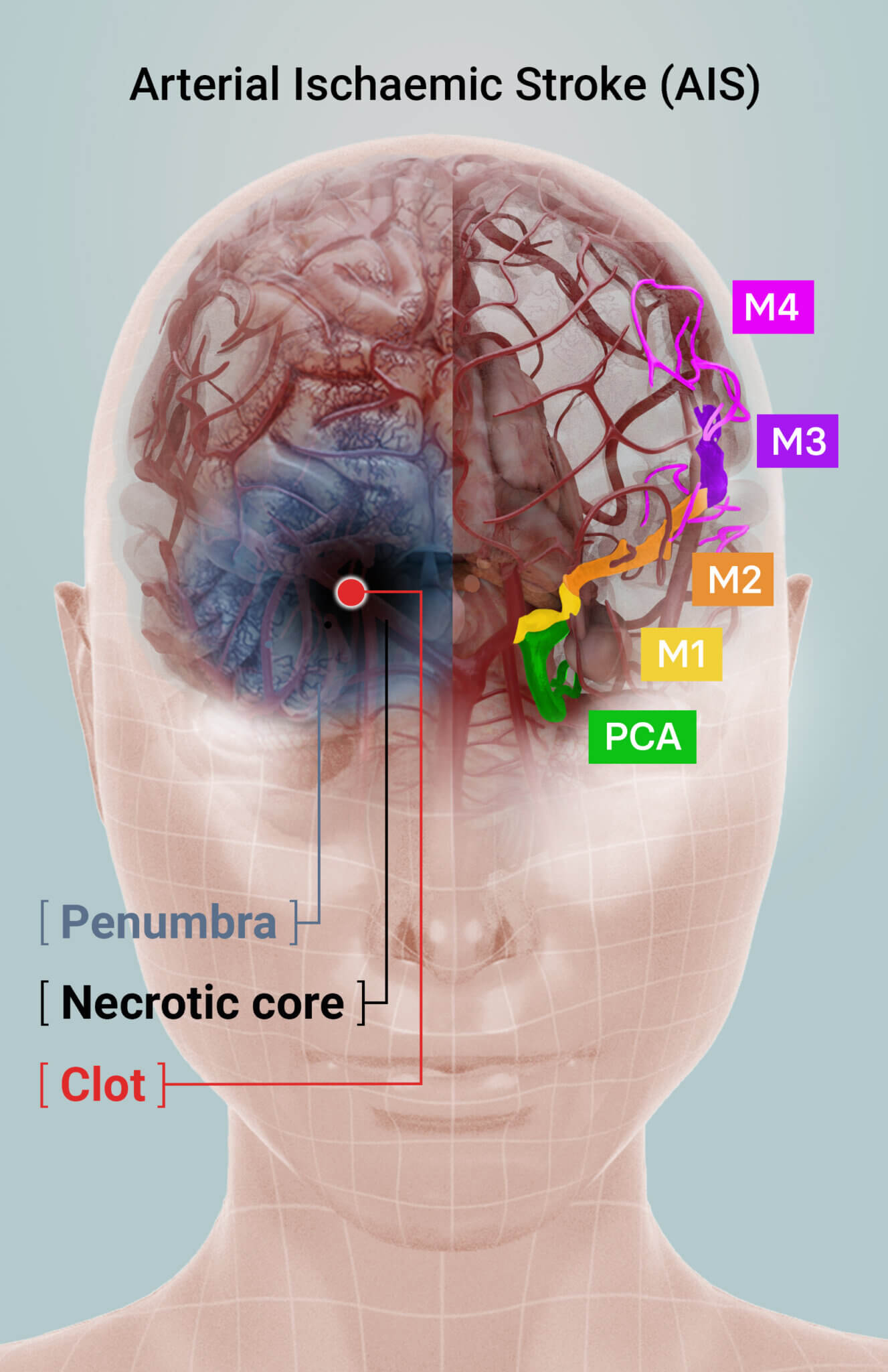 Afamelanotide well tolerated by first stroke patients - Clinuvel