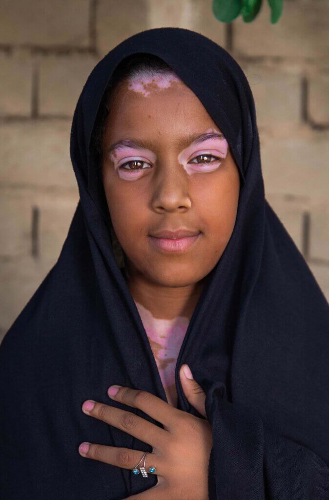 Depigmentation in a young vitiligo patient with darker skin complexion