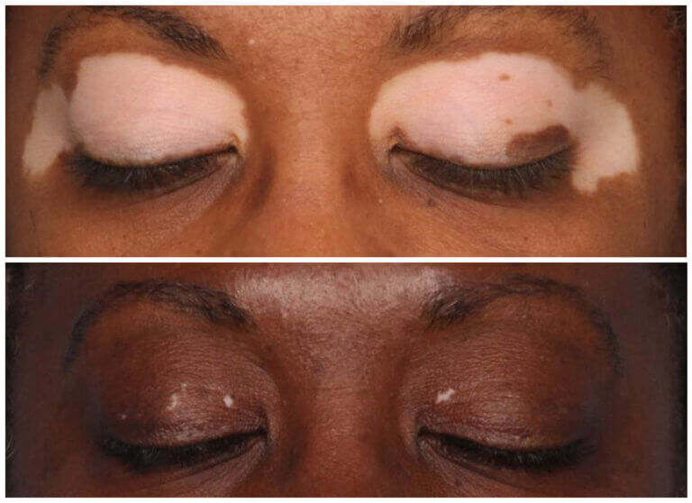 CLINUVEL progresses vitiligo treatment program CLINUVEL