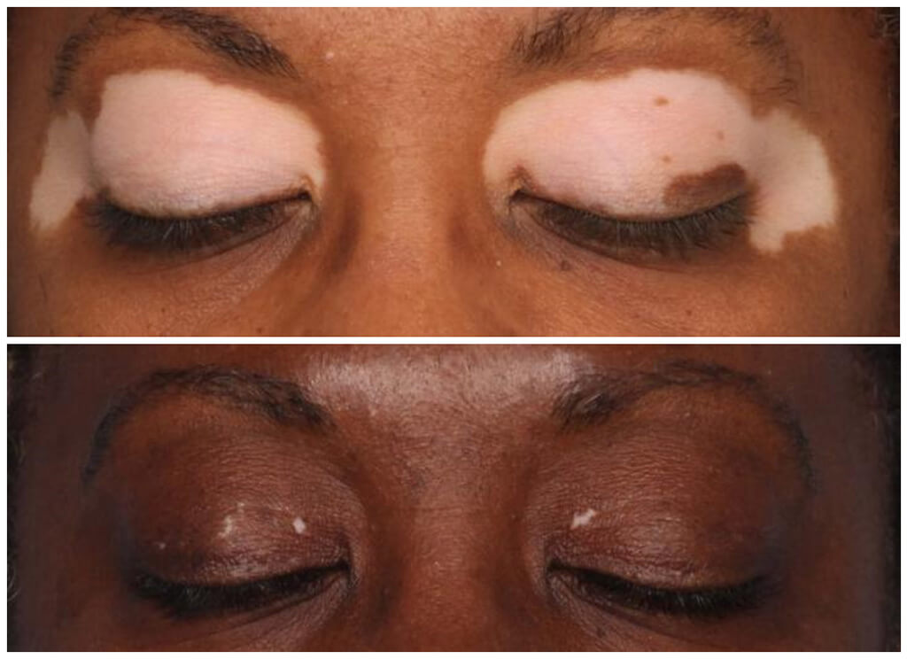 Photo: Vitiligo patient repigmentation eyes