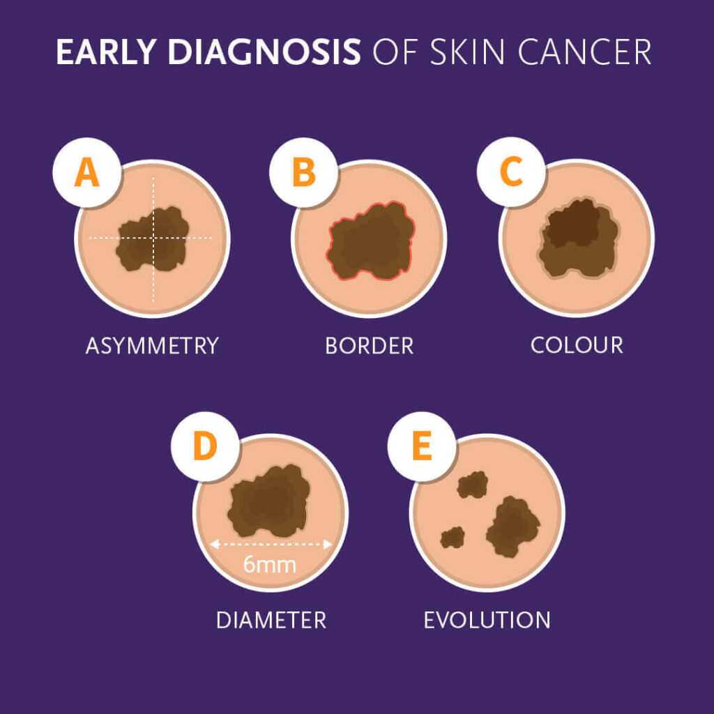 Self Examination Guide Mole map CLINUVEL